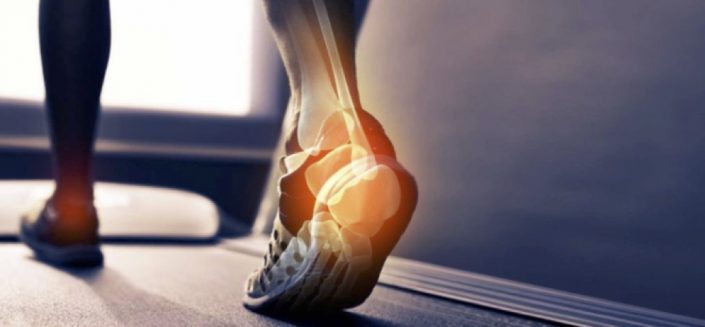 Fascite plantar Fascite plantar