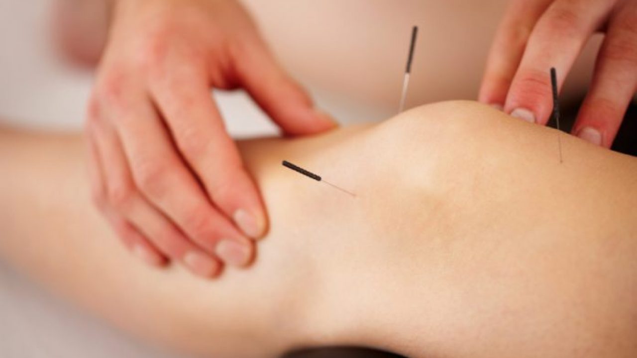 Acupuntura, conheça os benefícios